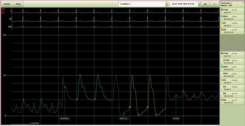 IMG-Merge-Web-Blog-Hemo-Pressures-001