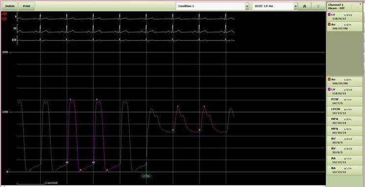 IMG-Merge-Web-Blog-Hemo-Pressures-002